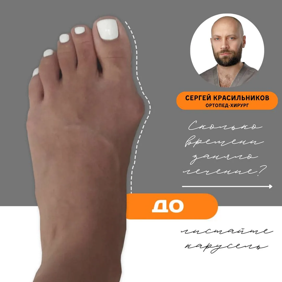 Сколько времени заняло лечение Hallux Valgus?