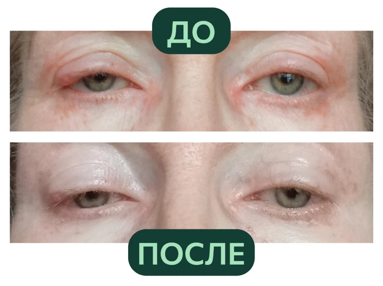 Как убрать воспаление в ЖКТ и не сделать себе хуже   Если вы годами живете со вздутием, тяжестью, пр
