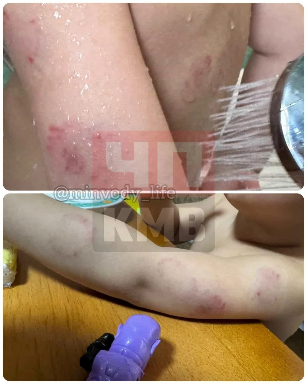 ❗️В Минераловодском округе расследуются появление укусов у ребенка. — пишет губернатор Владимиров.  
