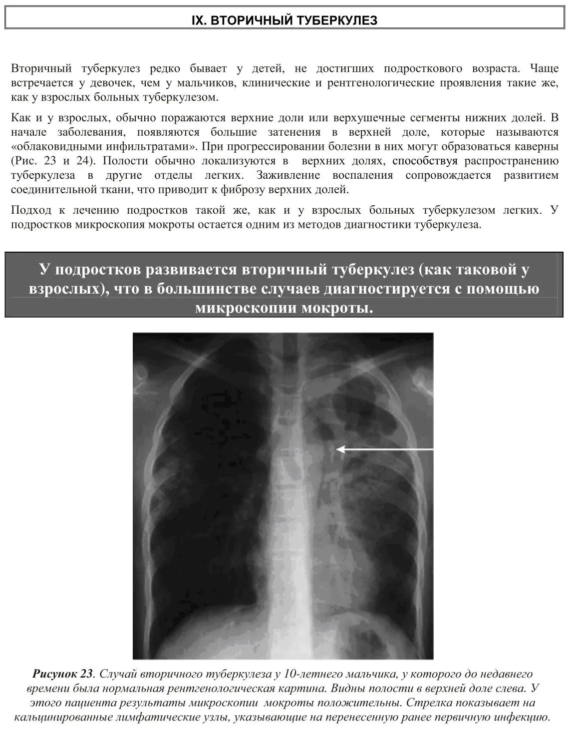 Вторичный туберкулез у детей и подростков
