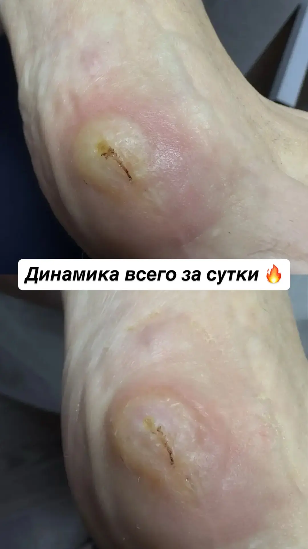 Тот самый случай, когда после обращения к хирургу стало хуже 🤷🏼‍♀️