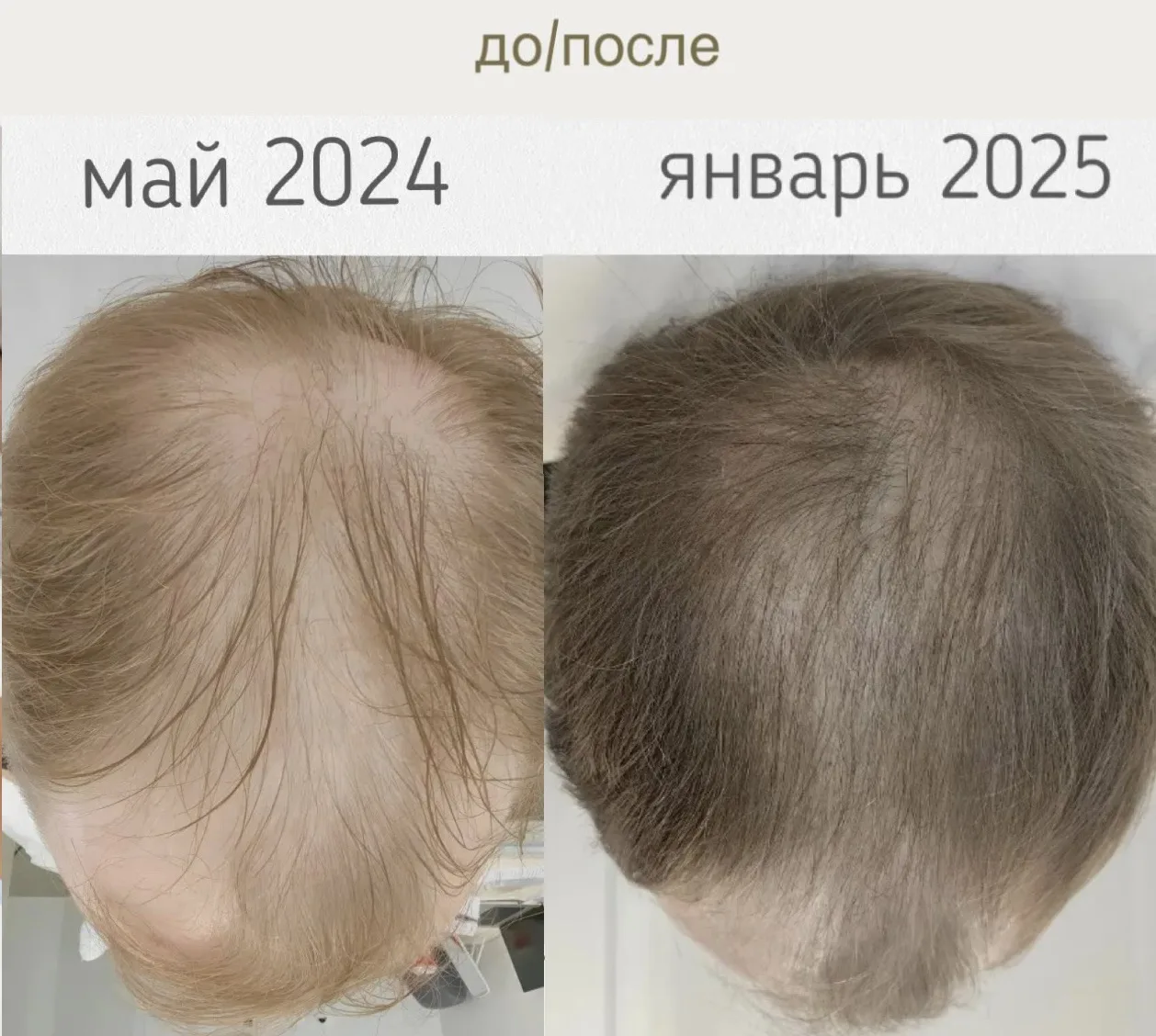 Убрали выпадение волос и запустили рост новых волос 🔥