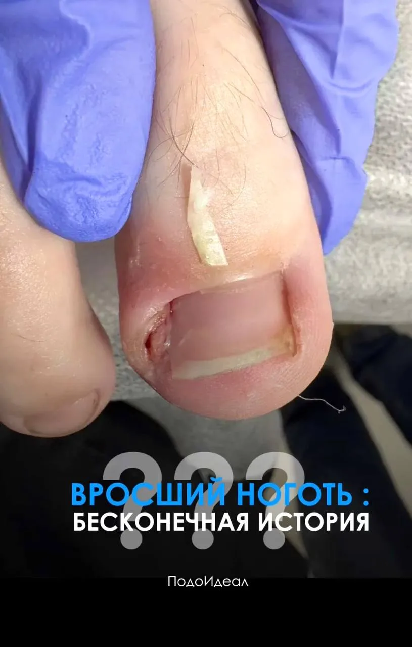Вросшие ногти