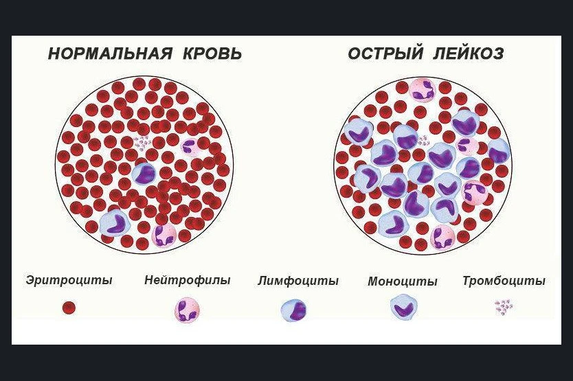 ЛЕЙКОЗ КРУПНОГО РОГАТОГО СКОТА – хроническая инфекционная болезнь с необратимым процессом, вызываема