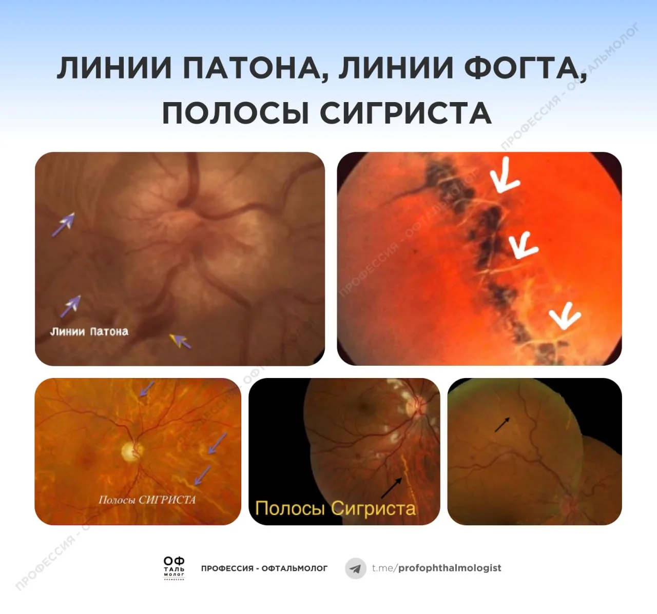 Клинические эпонимы глазного дна: линии и полосы