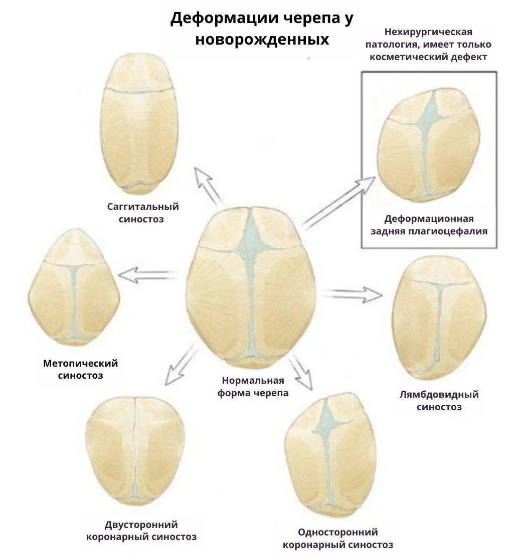 🧒Деформация черепа у детей: что важно знать педиатру?