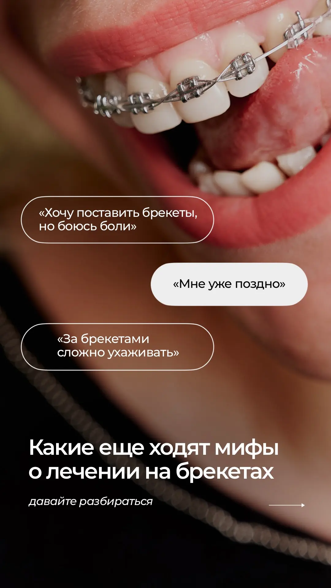 📌МИФЫ О БРЕКЕТАХ
