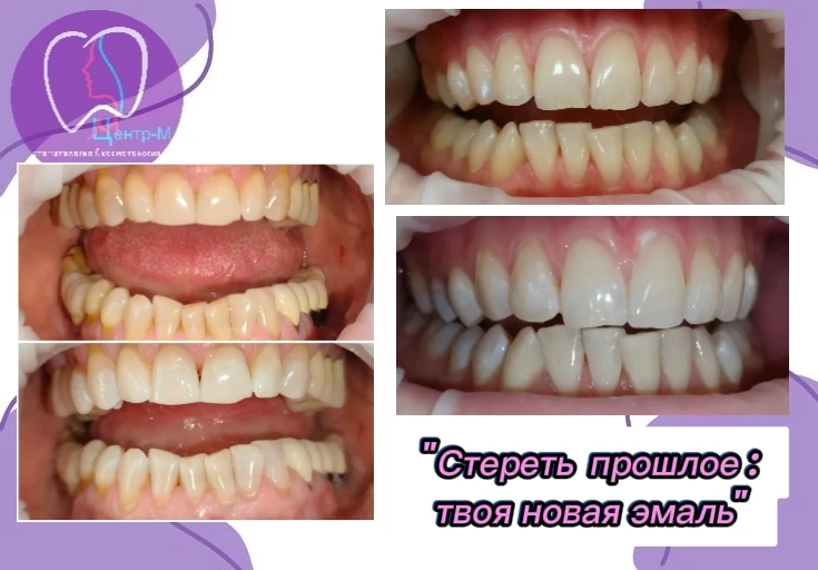 ✨ Как подготовиться к отбеливанию и не навредить эмали? ✨
