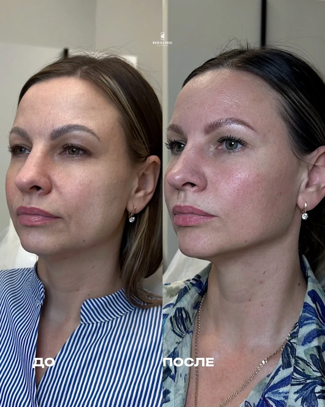 Не понимаете, подойдёт ли вам полимолочная кислота? Есть простой ориентир 👇