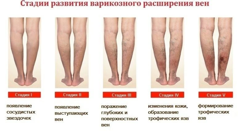 Стадии развития варикозного расширения вен