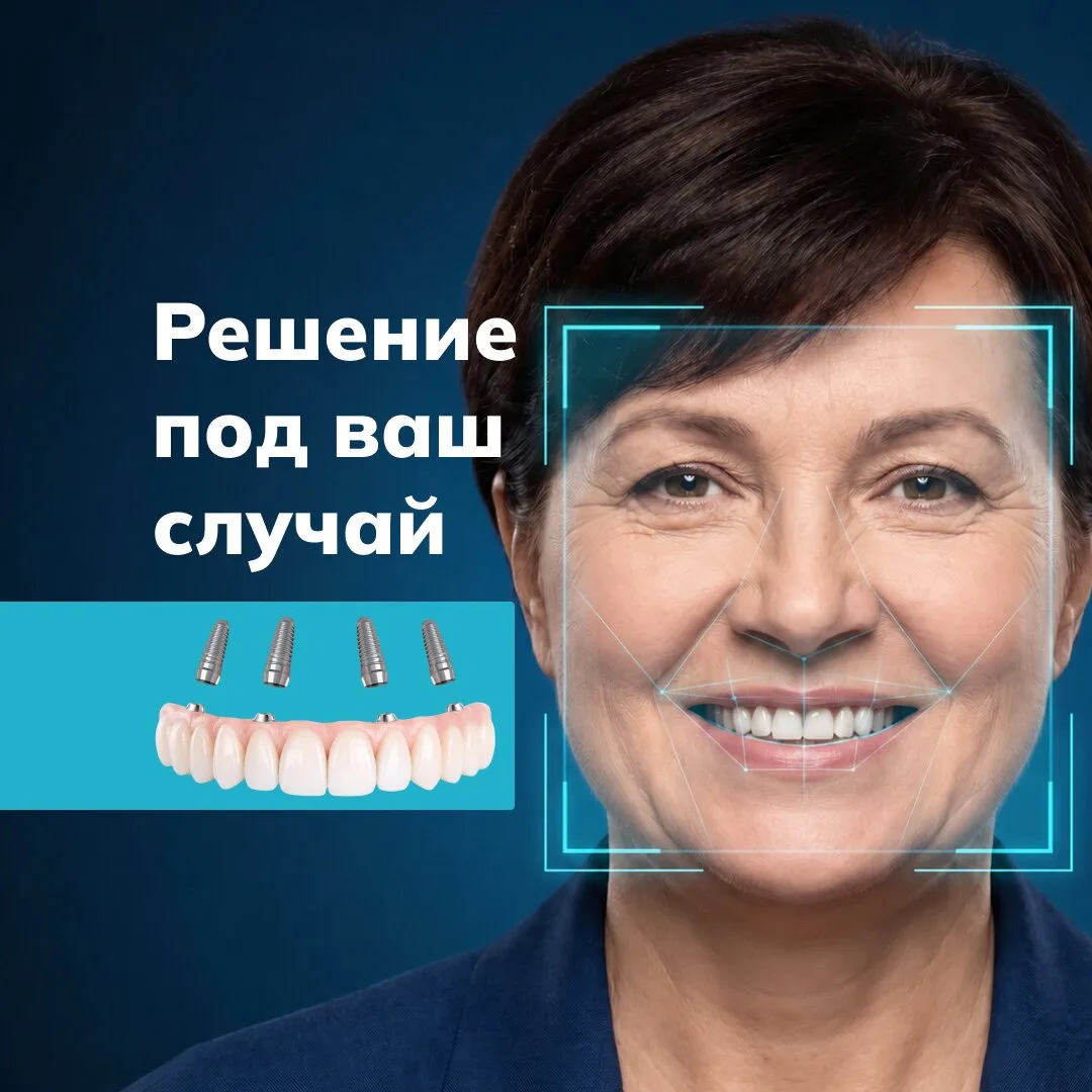 Восстановление всех зубов на 4-х имплантах