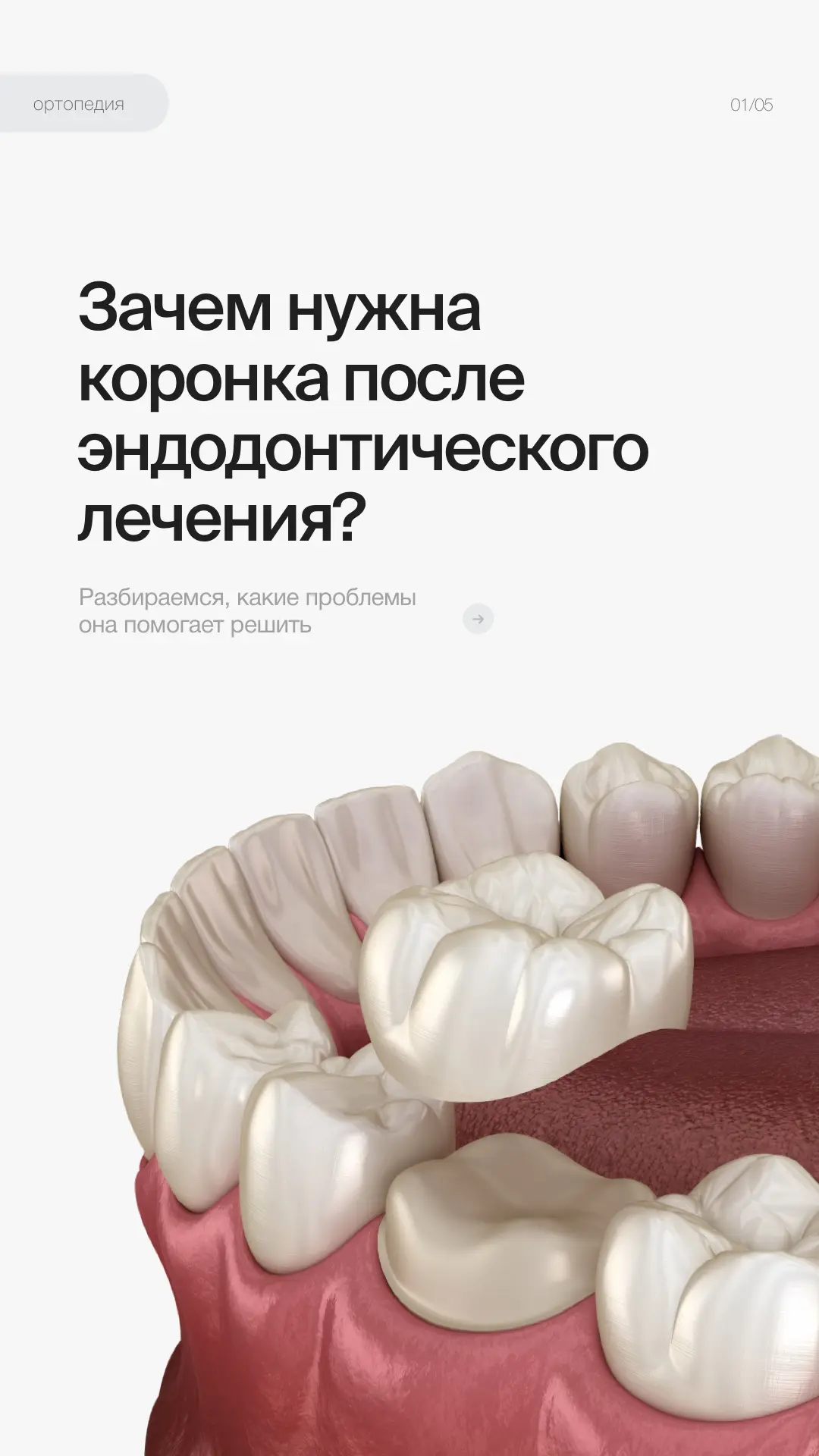 📌 ЗАЧЕМ НУЖНА КОРОНКА ПОСЛЕ ЭНДОДОНТИЧЕСКОГО ЛЕЧЕНИЯ