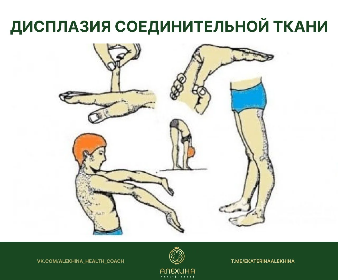В чате меня спрашивали о нутрицевтической поддержке при  дисплазии соединительной ткани. Давайте раз