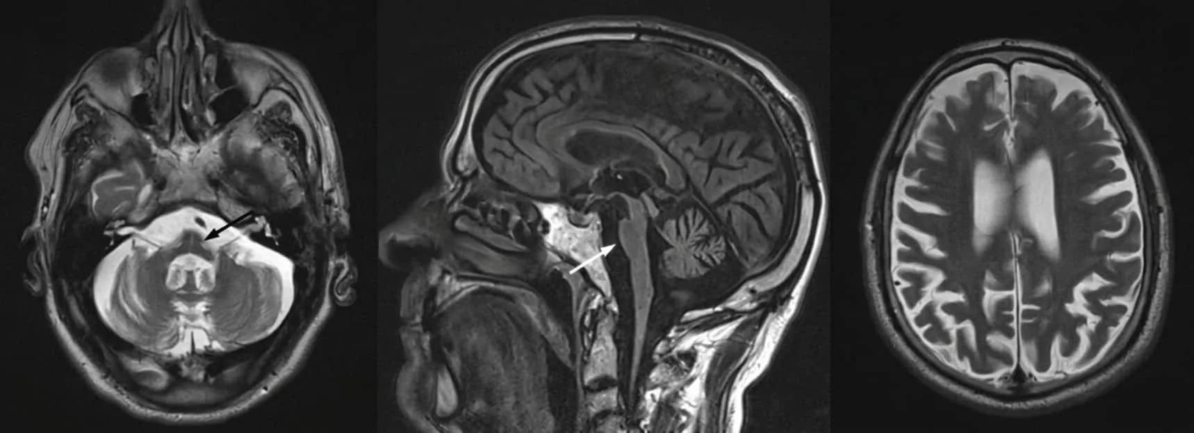 Ученые развеяли 70-летний миф о «рептильном мозге» человека
