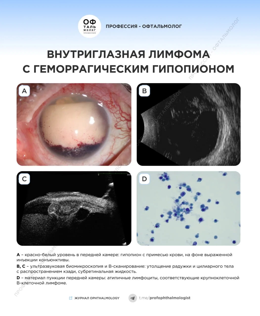 Правильный ответ – внутриглазная лимфома