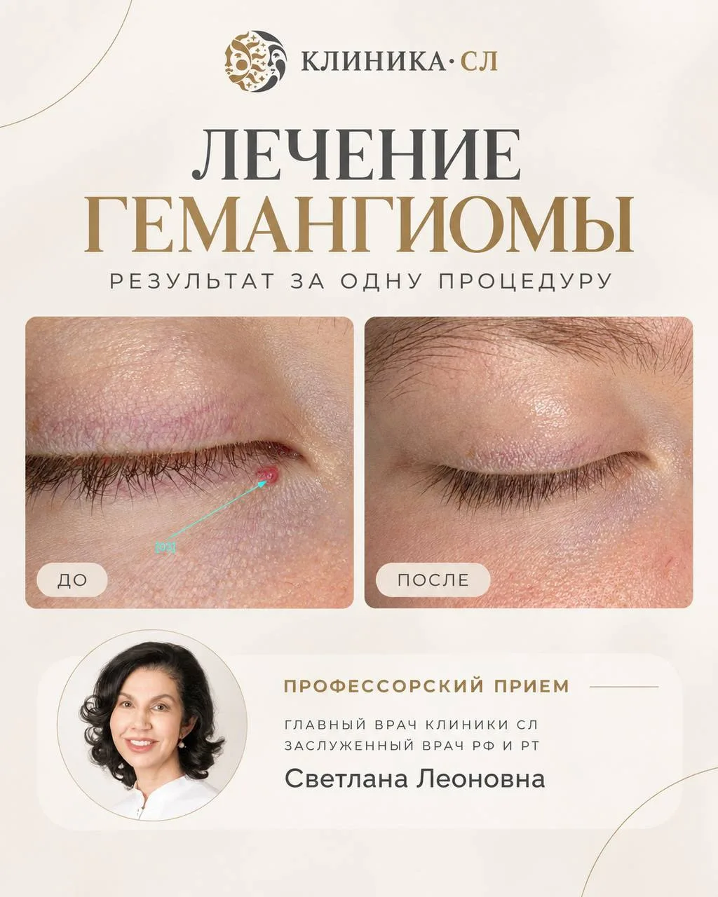 Результат всего за одну процедуру ✨