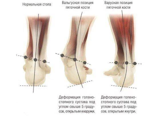 👣 ПОЧЕМУ СТОПА ЗАВАЛИВАЕТСЯ ВНУТРЬ ИЛИ НАРУЖУ?   Скажем сразу, не надо думать, что все проблемы от с