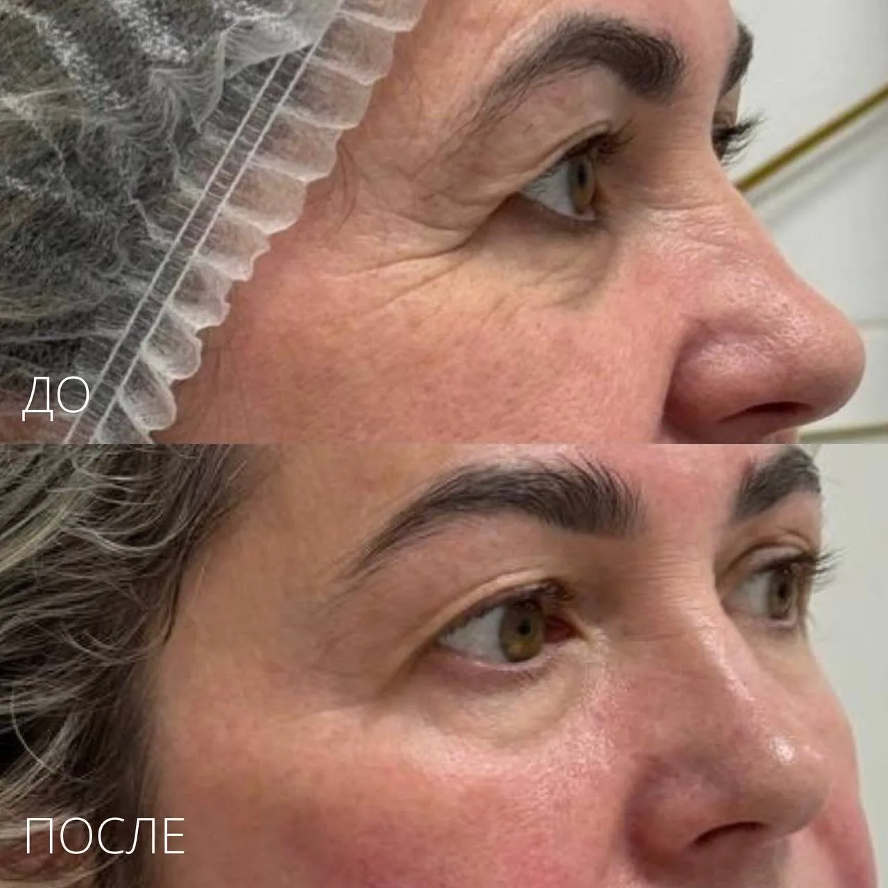 Омоложение с эффектом «WOW» ✨

Oligio — процедура термолифтинга, которая даёт эффект омоложения и по