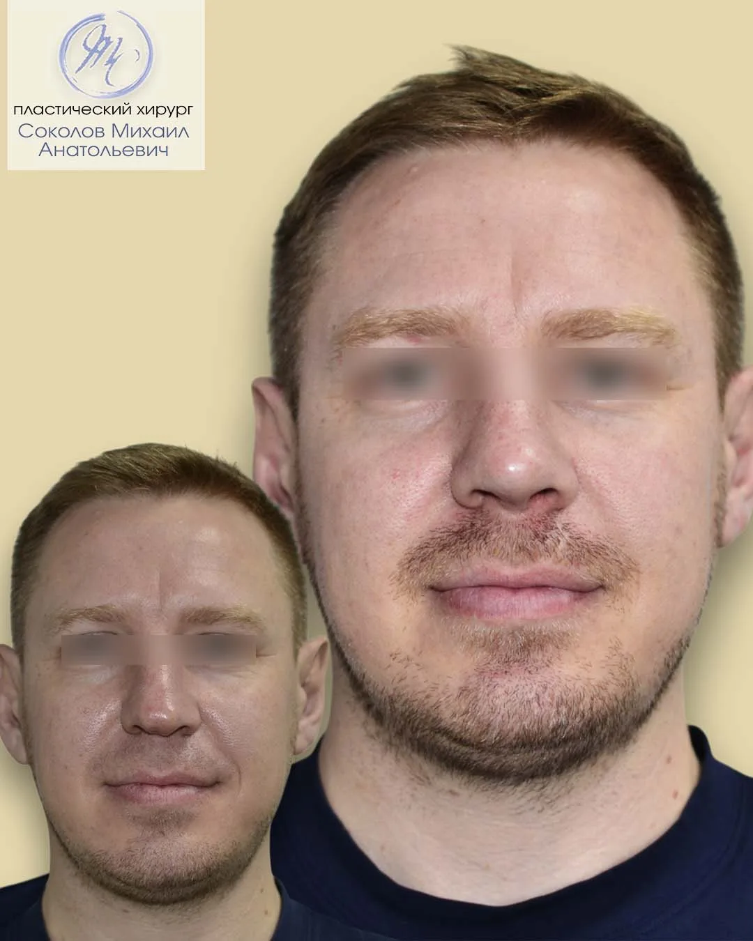 РИНОПЛАСТИКА