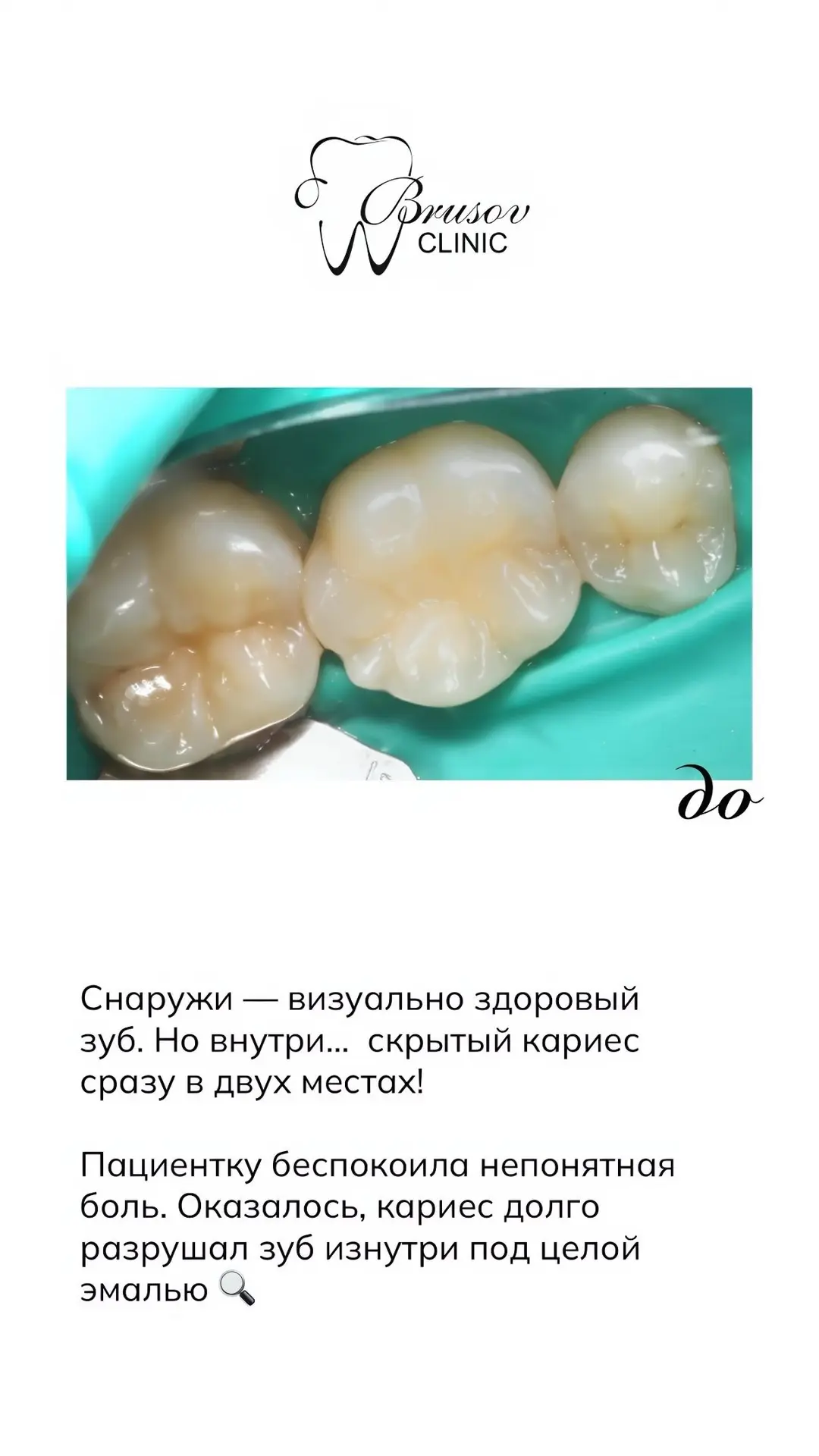 ДО/ПОСЛЕ 🤍

Пациентку беспокоила непонятная зубная боль. Оказалось, скрытый кариес в двух местах до