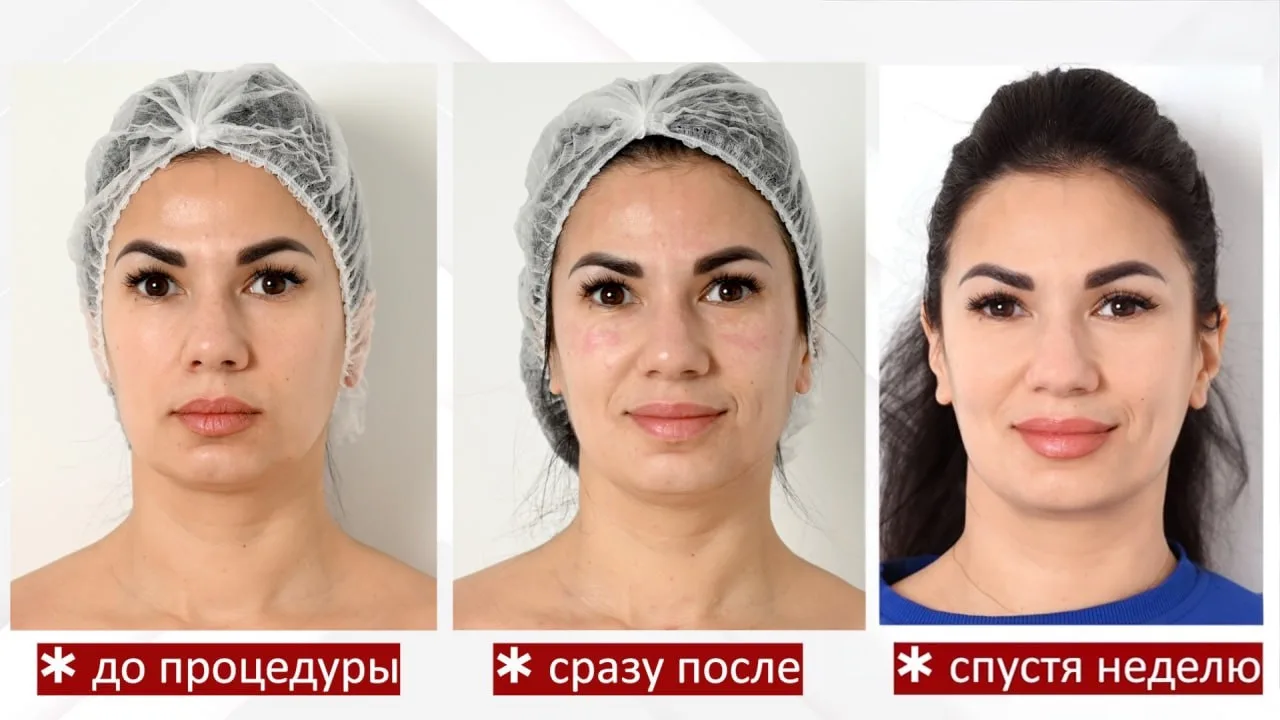 Процедура «Суперсияние и упругость»
 
Сияющая кожа с естественным свечением и блеском - первый призн