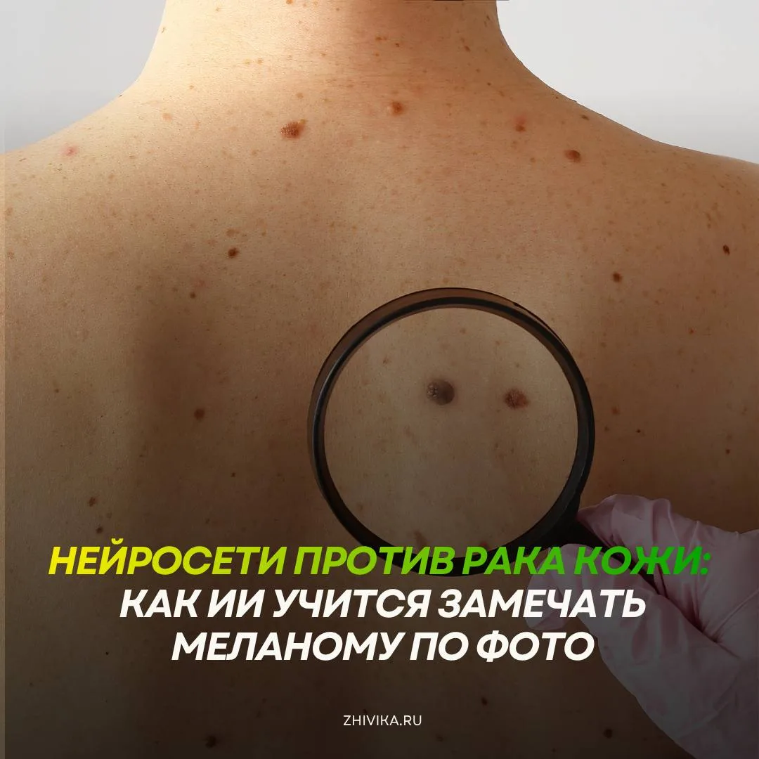 Может ли ИИ увидеть опасную родинку раньше человека? 🤖🔬

Искусственный интеллект уже давно переста