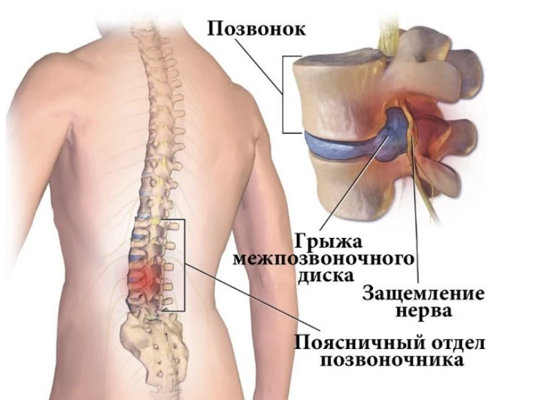 Хиджама (баночное кровопускание) не лечит межпозвоночную грыжу, но может временно умень...