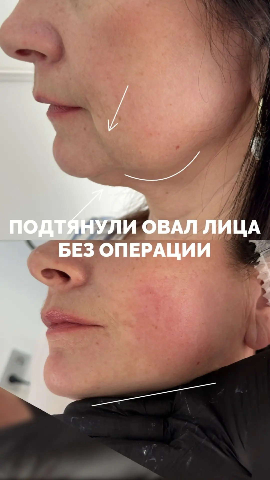 Лифтинг лица без операции🔥
