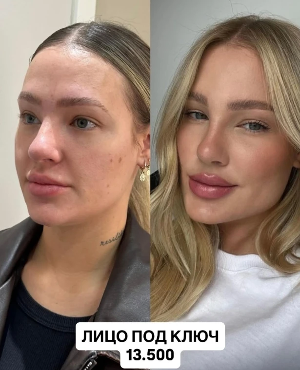 👄 УВЕЛИЧЕНИЕ ГУБ ОТ 4 000 ₽ | КОСМЕТОЛОГИЯ ПОД КЛЮЧ 13 500 ₽

Работаем более 10 лет
❗ Есть медицинс