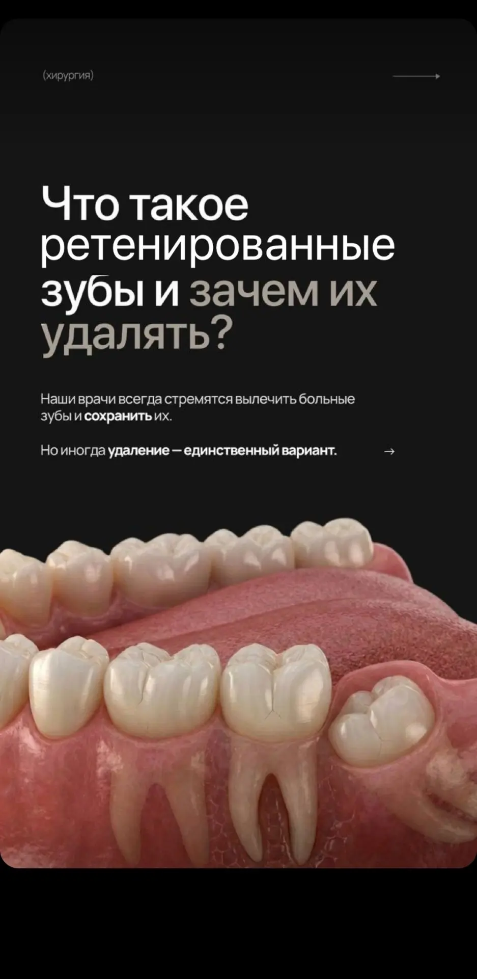 🦷РЕТЕНИРОВАННЫЕ ЗУБЫ🦷