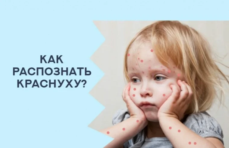 Краснуха.
 
Краснуха – это высокозаразная вирусная инфекция, передающаяся воздушно-капельным путем. 