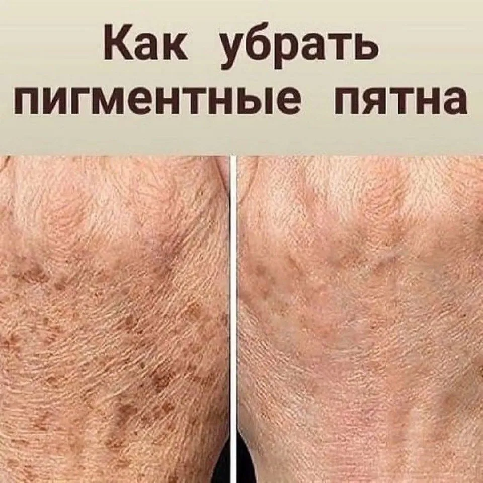 Убираем пигментные пятна!
⠀
Вам понадобится:
⠀
2 ст. л. лукового сока;
2 ст. л. уксуса 9 %.
⠀
Смешай
