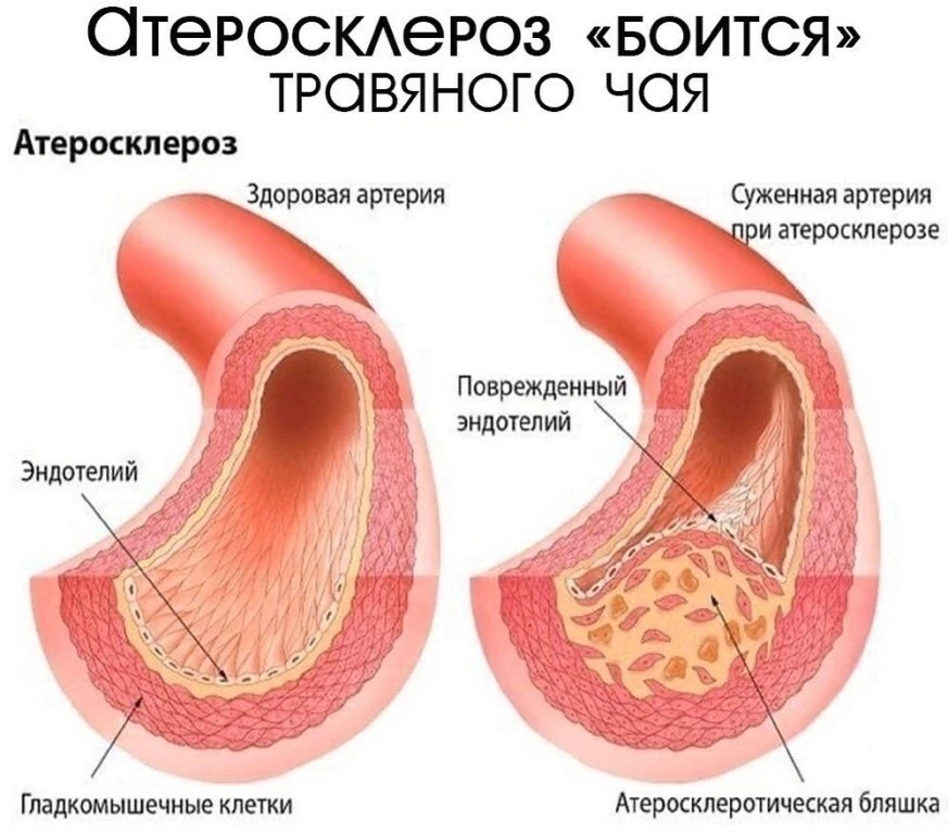 Атеросклероз «боится» травяного чая  ⠀⠀  Старость – это неизбежно, со старостью «под ручку» приходят