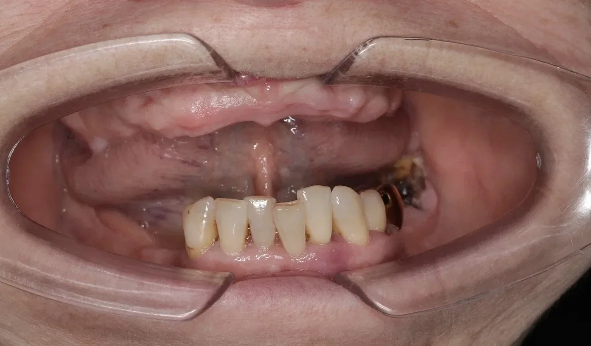 ДО/ПОСЛЕ. История нашей пациентки Людмилы 🦷  Восстановили все зубы за 3 дня!  Людмила Петровна обрат