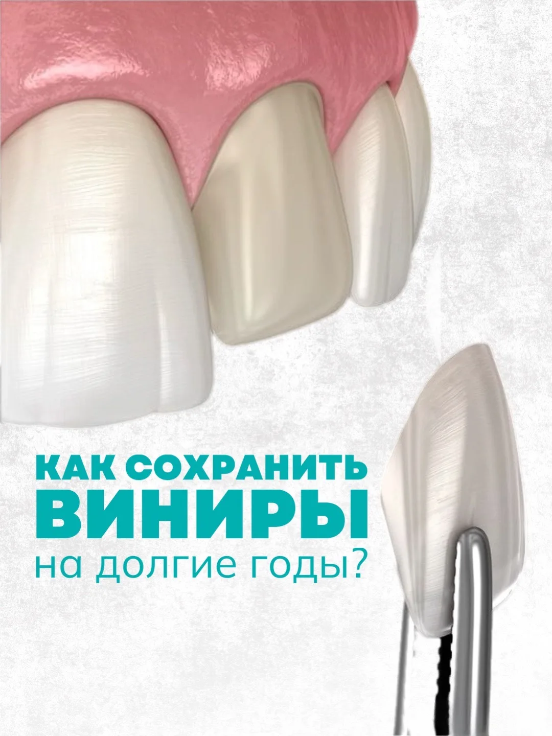 Как долго прослужат виниры? 🦷