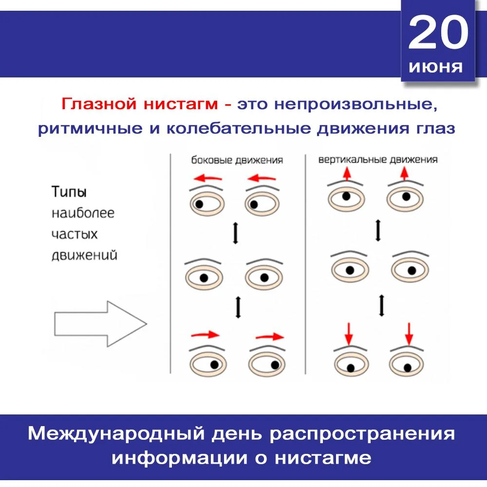 📢 20 июня — Международный день распространения информации о нистагме 📢

Сегодня мы хотим обратить 