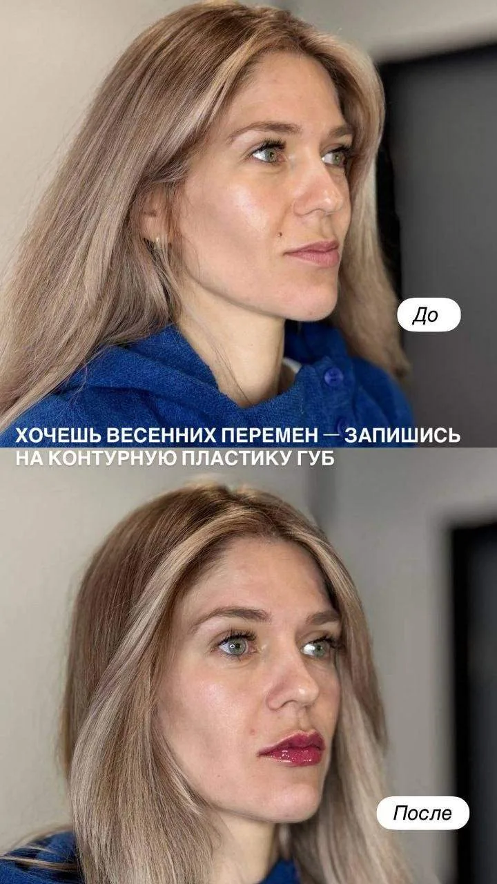Мечтаете о красивых, ухоженных губах, которые выглядят естественно и гармонично?

Процедура позволяе