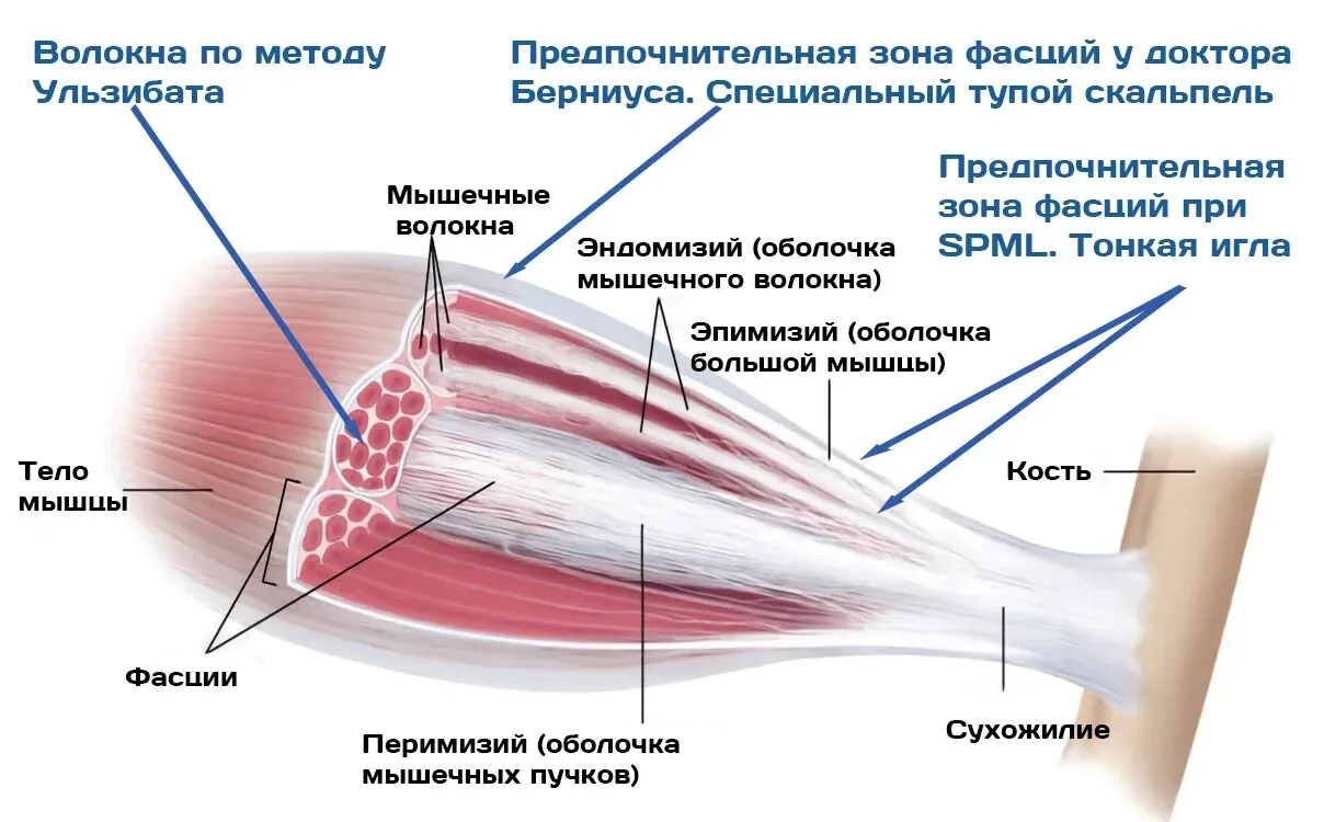 Когда консервативные методы уже не дают нужного объёма движений: про операцию по методу...