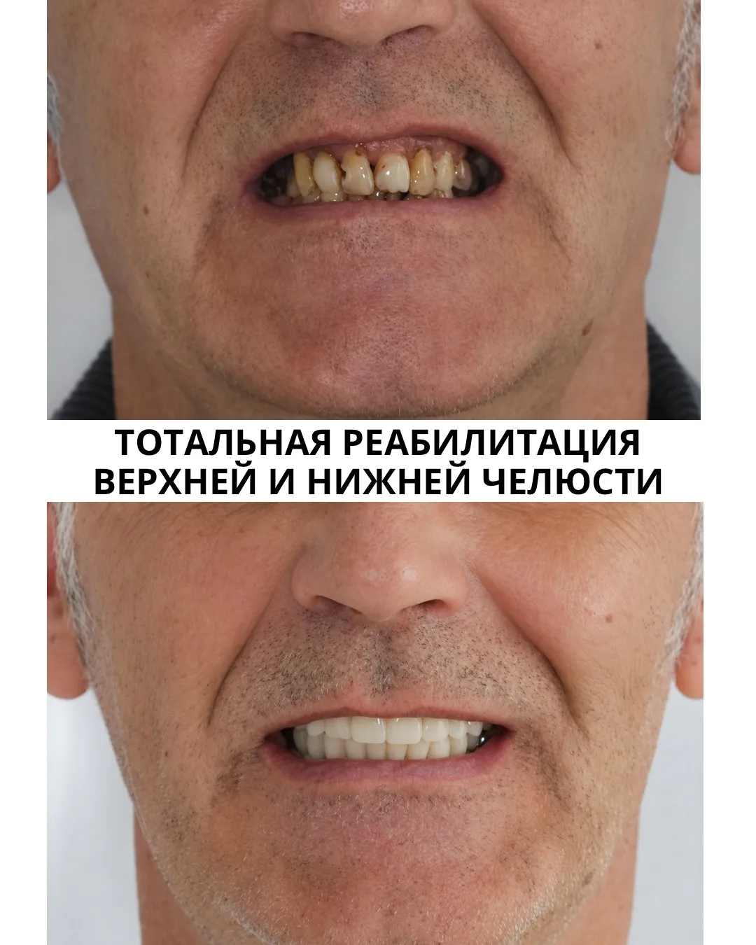 🦷 В стоматологии есть золотое правило: мы боремся за каждый зуб до последнего.