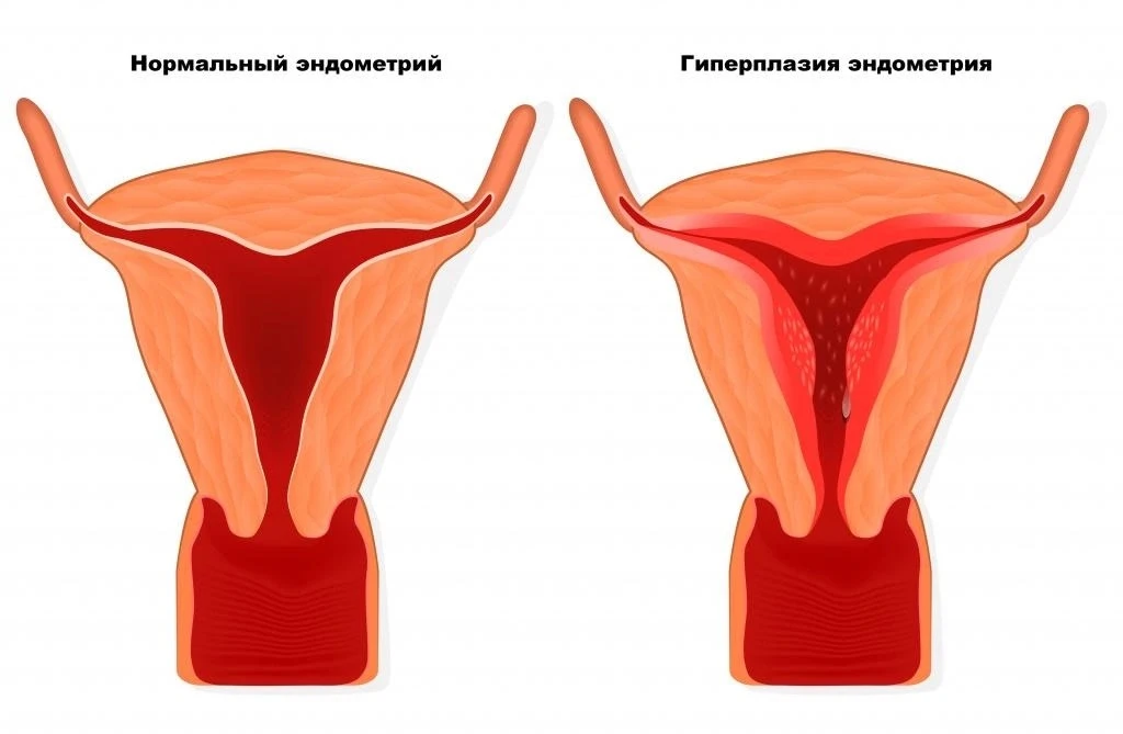 Гиперплазия эндометрия: что с ней делать?