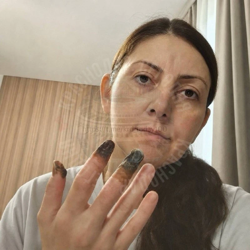 📌После капельницы в роддоме Сочи женщине грозит удаление частей двух пальцев