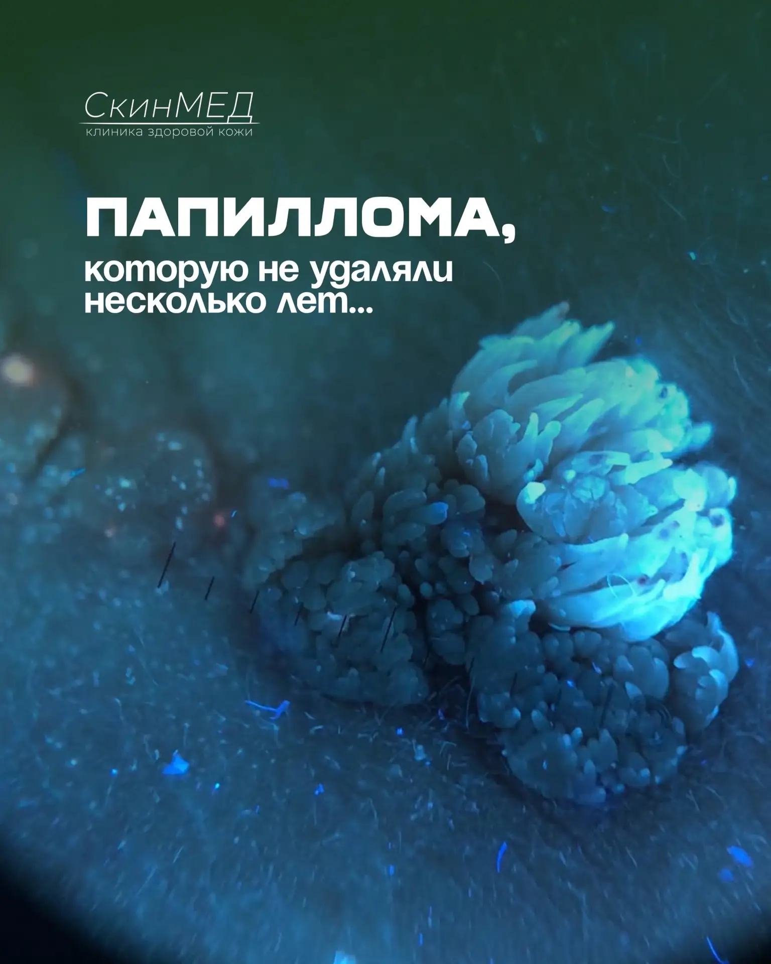 «Папиллома, которую не удаляли несколько лет…»