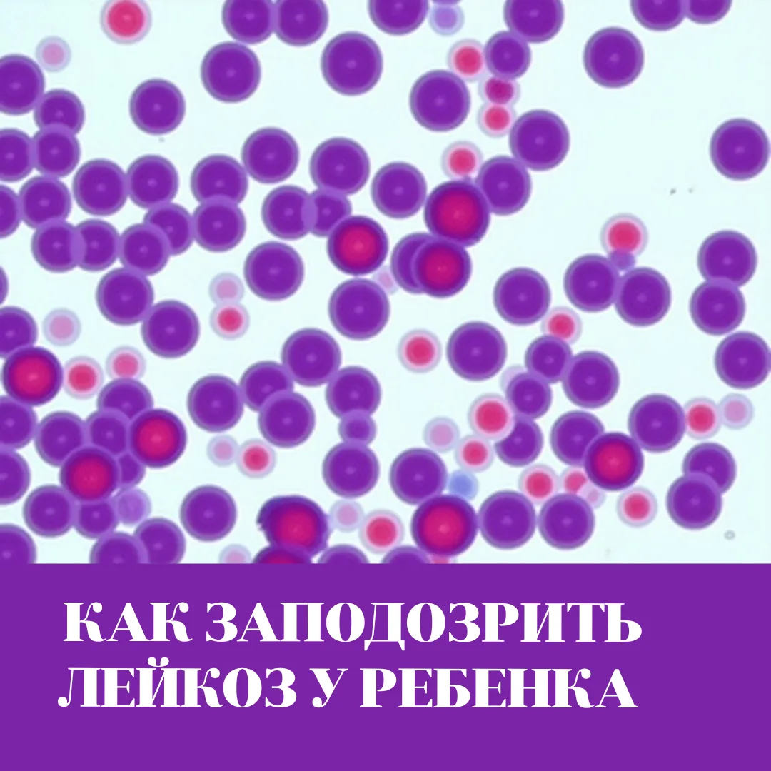 Лейкоз у ребенка: на какие симптомы родителям нужно обратить внимание?