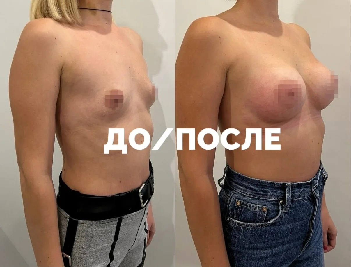 Увеличение груди.
 
Работа пластического хирурга Веркеевой Анны Леонидовны.
 
Имеются противопоказан