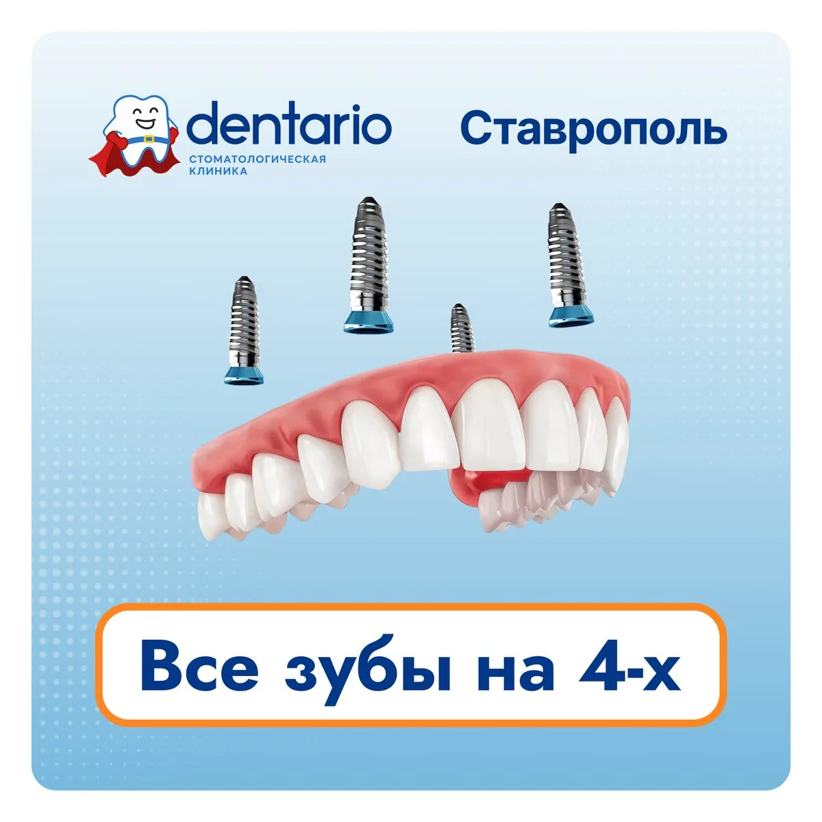 Несъёмное протезирование всей челюсти на 4-х имплантах