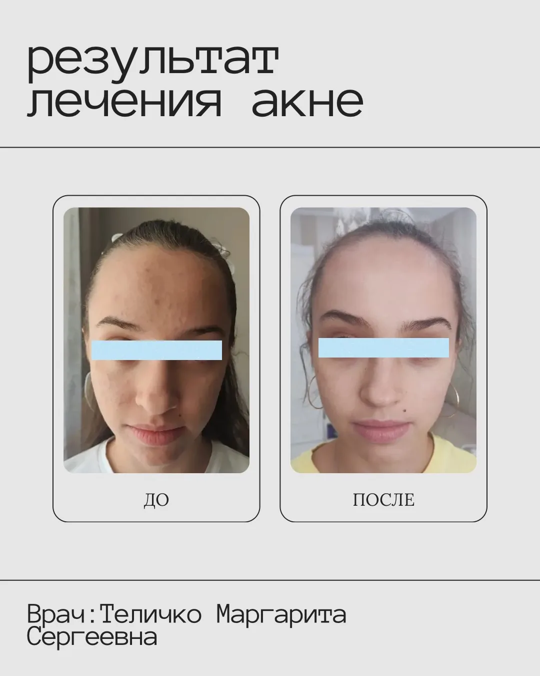 ✔️Результат после: комплексного лечение акне.