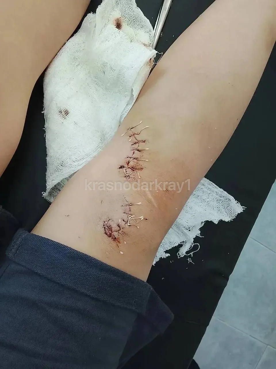 В хуторе Усатова Балка ребёнок получил серьёзную травму ноги после падения на залежи битого стекла р