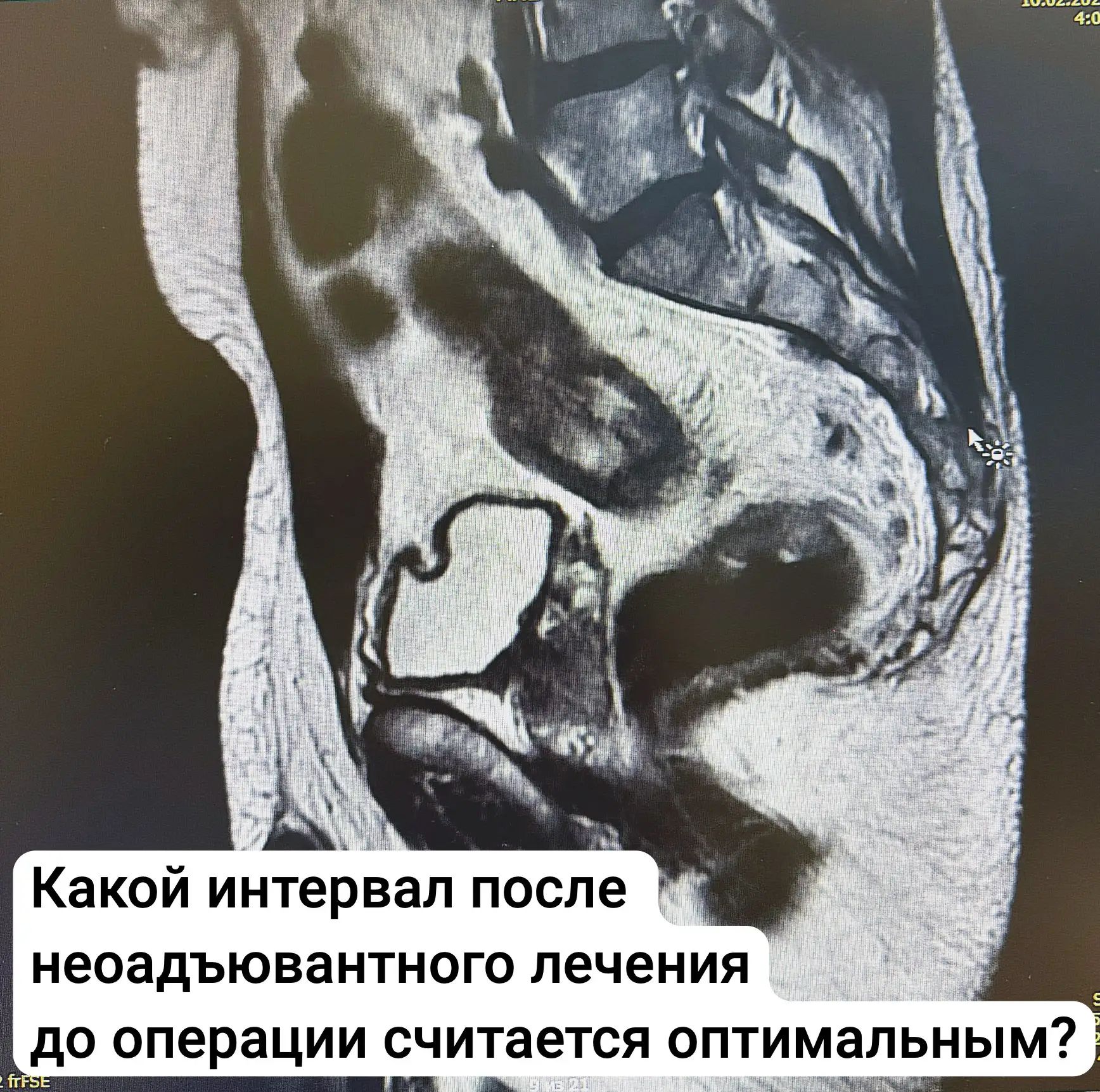 ⏱ Когда оперировать рак прямой кишки после неоадъювантной терапии?