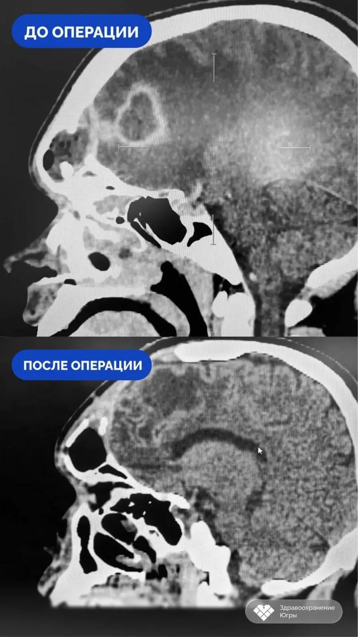 😵 Сам пытался вылечить насморк и получил отек мозга — ему сделали трепанацию черепа.