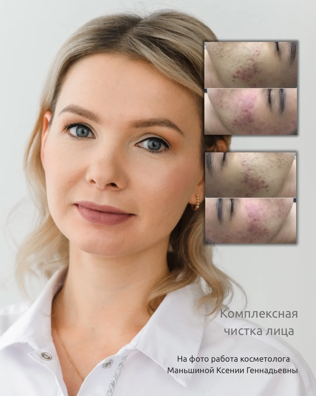 Чистка лица — это не просто уход, а база здоровой кожи ✨